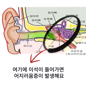 이석증
