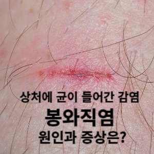 상처에 균이 들어간 감염봉와직염 원인과 증상은?