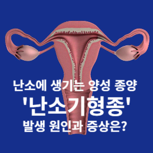 난소에 생기는 양성종양 난소기형종 발생 원인과 증상은?
