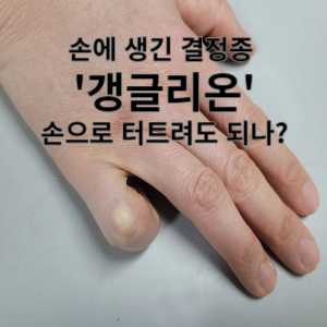손에 생긴 결정종 갱글리온 손으로 터트려도 되나?
