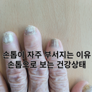 손톱이 자주 부서지는 이유 손톱으로 보는 건강상태 