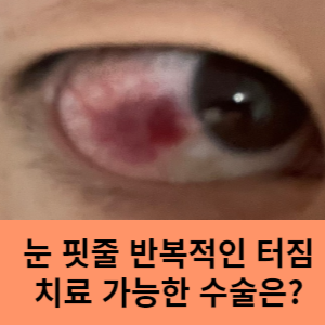 눈 핏줄 반복적인 터짐 치료 가능한 수술은?