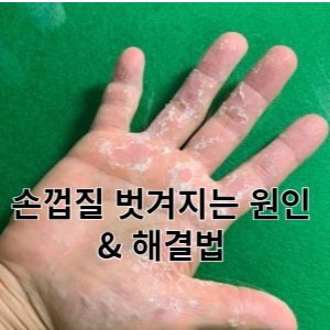 손껍질 벗겨지는 원인 & 해결법 