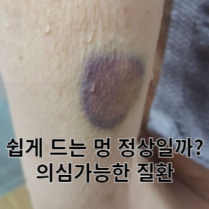쉽게 드는 멍 정상일까? 의심가능한 질환