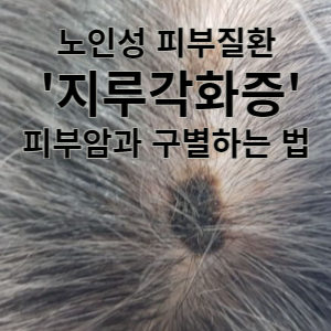 노인성 피부질환 지루각화증 피부암과 구별하는 법 
