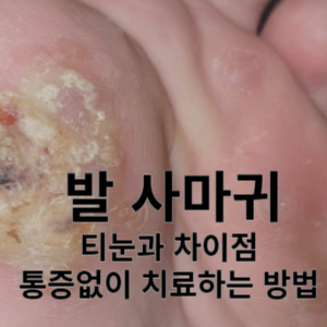 발 사마귀 티눈과 차이점 통증없이 치료하는 방법 