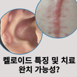 켈로이드 특징 및 치료 완치 가능성?