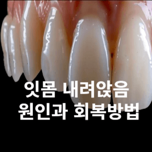 잇몸 내려앉음 원인과 회복방법
